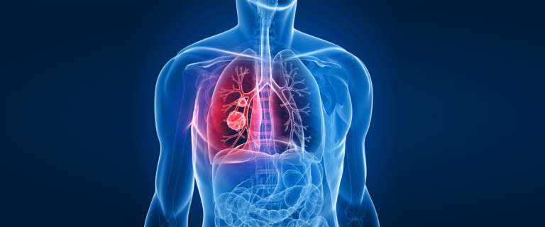 Compresión neumática intermitente de la pierna y profilaxis farmacológica para la prevención de la tromboembolia venosa en pacientes de alto riesgo