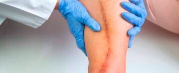 Cuidado de Heridas y Cicatrices: Adiós a los Seromas y la Ansiedad Post-Operatoria