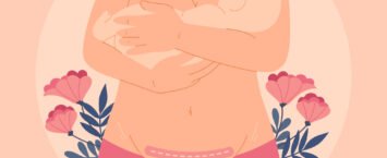 ¿Qué hacer para que la cicatriz de la cesárea tenga mejor aspecto y cuidarla?