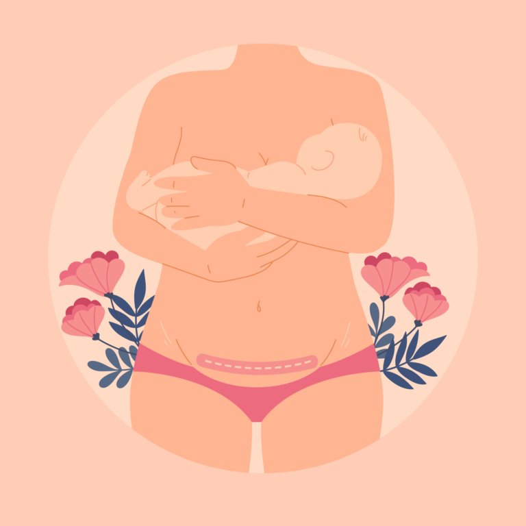 ¿Qué hacer para que la cicatriz de la cesárea tenga mejor aspecto y cuidarla?