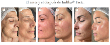 Radiofrecuencia Estética: El Poder del Calor para Combatir la Flacidez Leve y Optimizar la Piel Post-Liposucción sin Cirugía