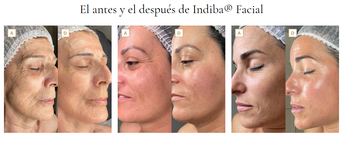 Radiofrecuencia Estética: El Poder del Calor para Combatir la Flacidez Leve y Optimizar la Piel Post-Liposucción sin Cirugía