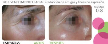 Más Allá de la Estética: 4 Usos Médicos de INDIBA que Transforman tu Bienestar