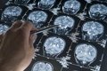 Señal Neuronal Anómala: Nueva Clave en los Mecanismos del Alzheimer