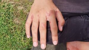 Brote de Sarna en Residencias: Retos Clínicos y Protocolos de Control Sanitario