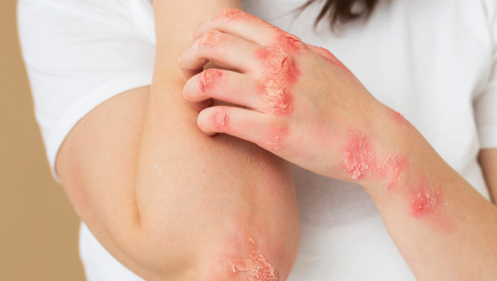 Dermatitis Atópica en Adolescentes: Manejo y Salud Mental