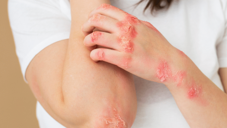 Dermatitis Atópica en Adolescentes: Manejo y Salud Mental