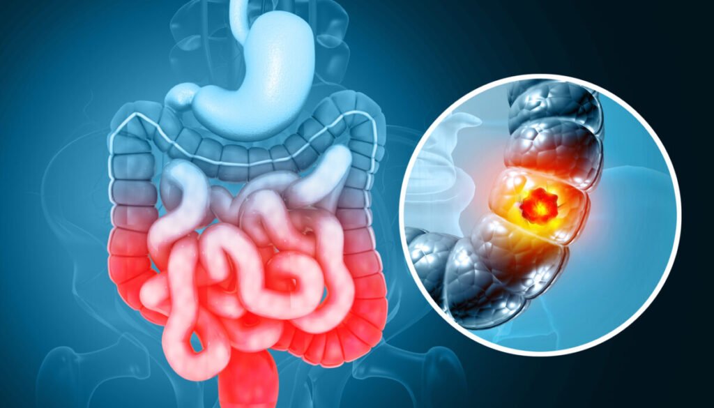 Cáncer Colorrectal: Avances en Prevención y Medicina de Precisión
