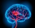 La Paradoja Cerebral tras un Ictus: Cuando los Mecanismos de Defensa Obstaculizan la Recuperación