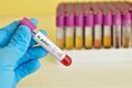 Helicobacter pylori y Cáncer Colorrectal: Nuevas Evidencias Clínicas sobre el Riesgo Global