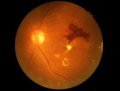 Nuevo tratamiento oral con danegaptide promete proteger la visión frente a la retinopatía diabética