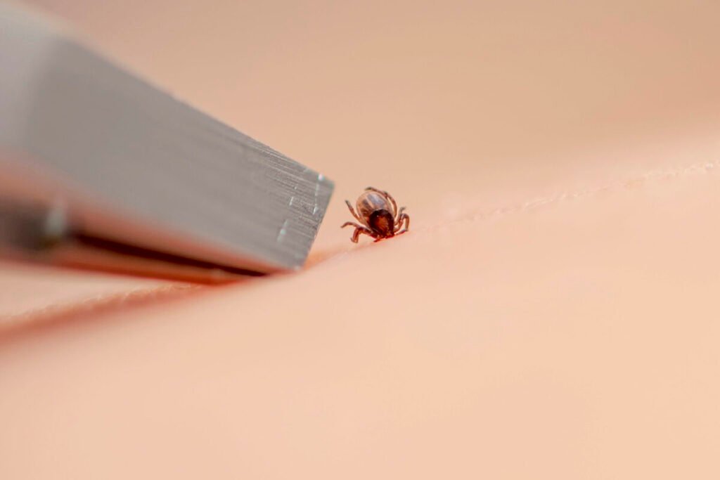 Nuevo Virus Transmitido por Garrapatas (ALTNV): Implicaciones Clínicas y Retos Diagnósticos