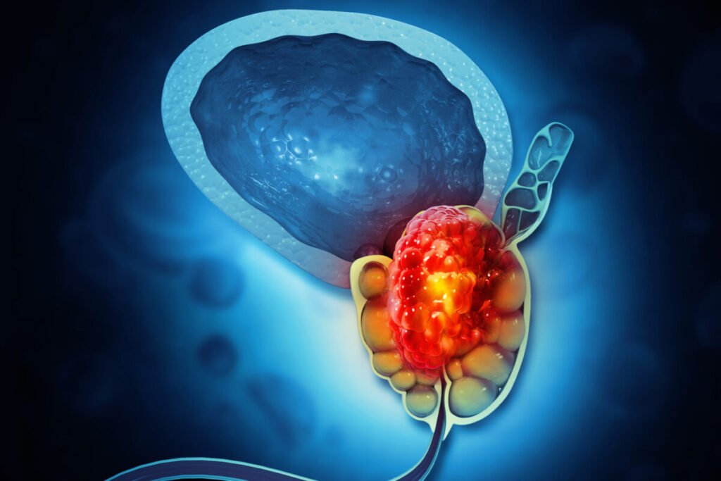 PET/TC con PSMA en Cáncer de Próstata: ¿Hacia una Reducción de Biopsias Innecesarias?