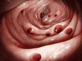Divertículos y Alimentos: Desmontando el Mito de las Semillas y Frutos Secos