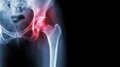 Artrosis de Cadera y Envejecimiento Saludable: Claves Clínicas para Proteger tus Articulaciones