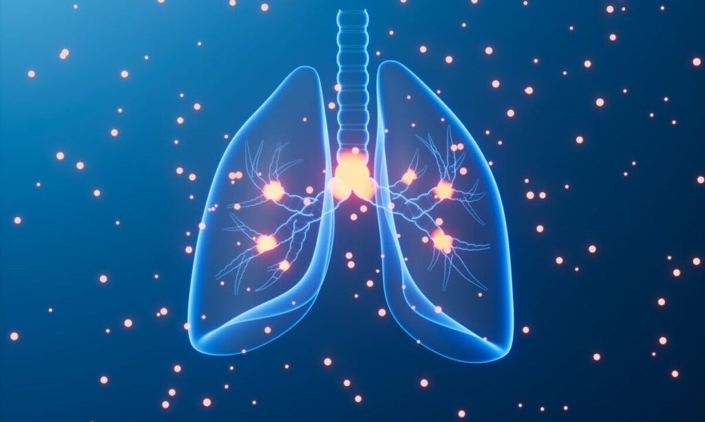 El microbioma como biomarcador clínico para predecir la respuesta a la inmunoterapia en cáncer de pulmón