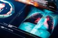 Nuevo Tratamiento Experimental Eleva la Supervivencia en Cáncer de Pulmón Avanzado