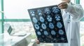 Terapia Génica para el Alzheimer Moderado: Avance Científico y Perspectivas