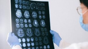 Inteligencia Artificial en el Diagnóstico y Tratamiento de Tumores Cerebrales