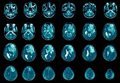 Biología del Glioma: Avances Científicos en el Cáncer Cerebral Agresivo