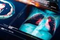 Microplásticos y Cáncer de Pulmón: Evidencia Científica y Riesgos Ocultos en el Aire