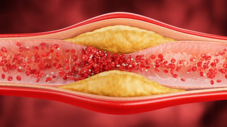 Nuevos Biomarcadores en Plasma Predicen la Aterosclerosis Subclínica y el Riesgo Cardiovascular