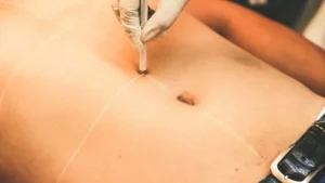 Cirugía Estética en Hombres: El Auge de los Tratamientos Complementarios al Ejercicio y la Musculación
