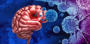 Nueva Generación de Radioterapia para Tumores Cerebrales: Avances del Proyecto InnovaRTBRAIN