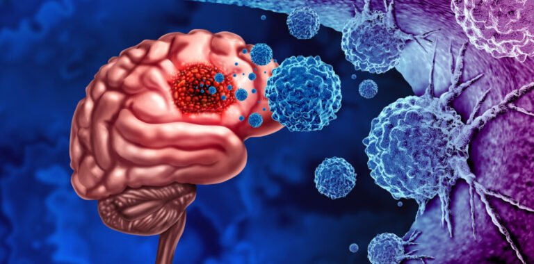 Nueva Generación de Radioterapia para Tumores Cerebrales: Avances del Proyecto InnovaRTBRAIN