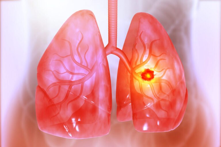Rybrevant y Lazcluze con Estrategias Profilácticas Reducen Tasas de Eventos Adversos en Cáncer de Pulmón