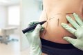 ¿Sirve la Liposucción para Adelgazar? Seis Mitos Clínicos Aclarados