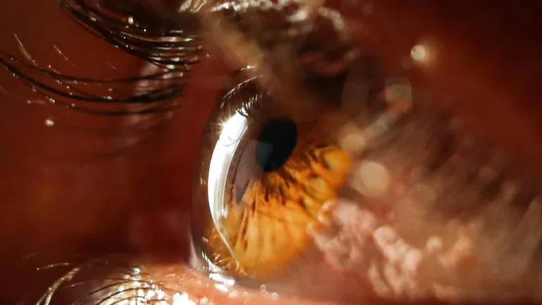 Glaucoma y Estatinas: ¿Menor Necesidad de Cirugía y Colirios?