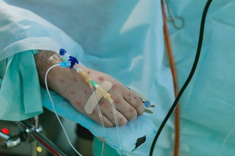 Fallecimiento por Mpox tras Contagio Nosocomial: Implicaciones Clínicas y Protocolos de Seguridad