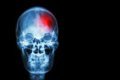 Microbioma e Ictus: Cómo las Bacterias Intestinales Modulan el Daño Cerebral