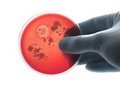 Tendencia Ascendente en los Casos de Meningitis: Análisis Clínico y Prevención