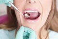 Células Madre de Pulpa Dental: Nueva Esperanza en la Recuperación del Ictus Isquémico